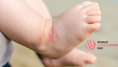 Photo of #UniteForAtopicEczema – Svjetski dan atopijskog dermatitisa